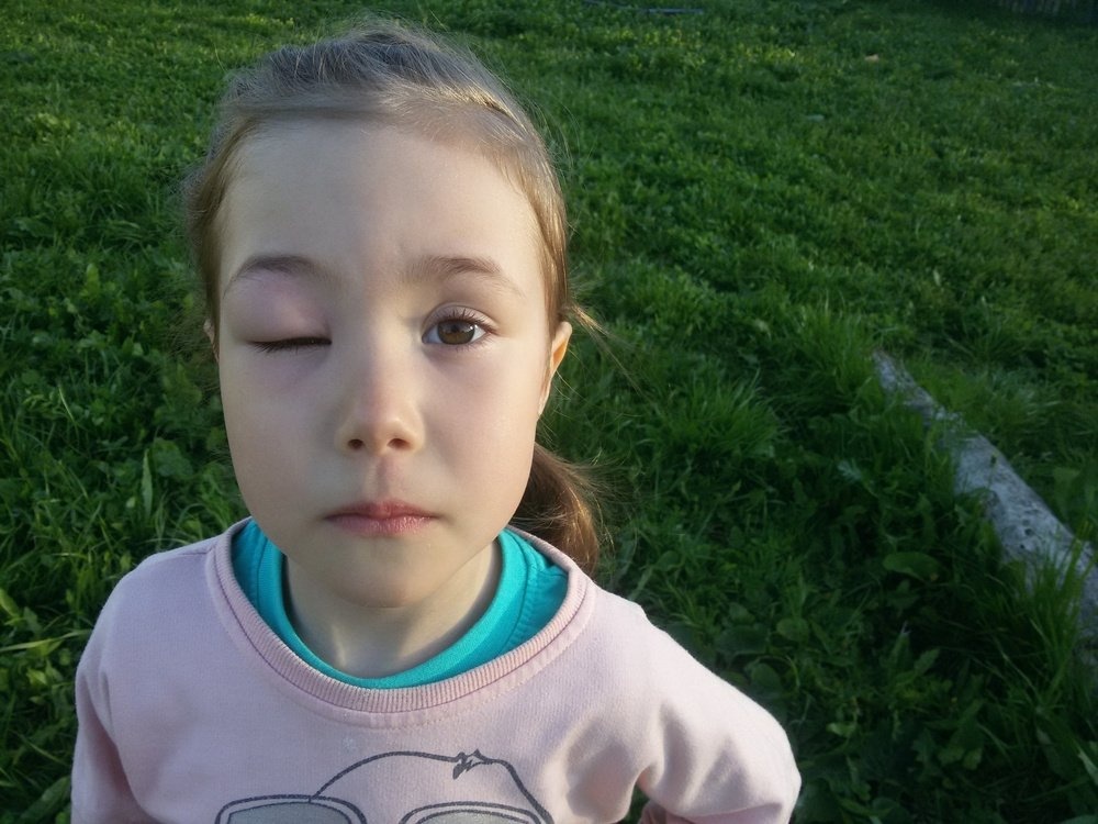 Что делать, если пчела ужалила в глаз?
