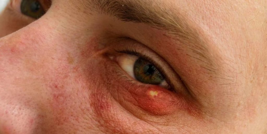 Может ли укус ячменя вызвать лихорадку
