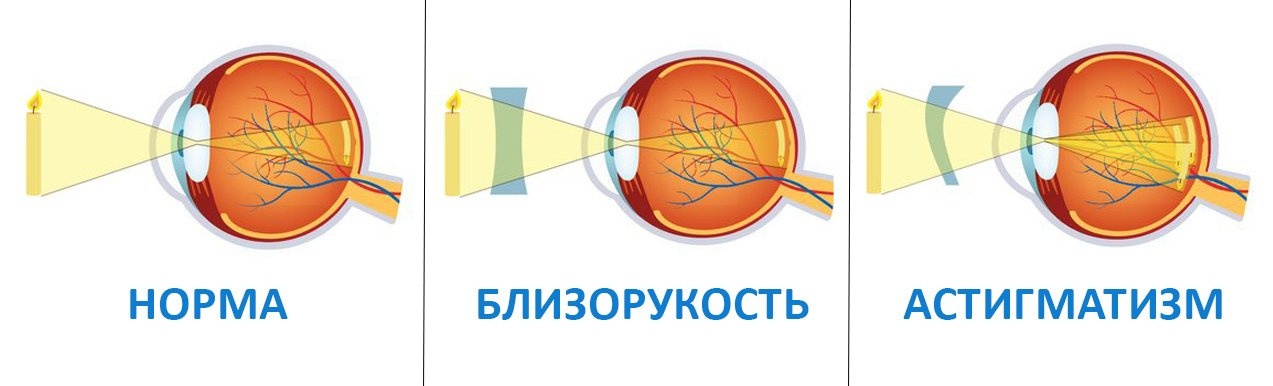 Разница между астигматизмом и близорукостью
