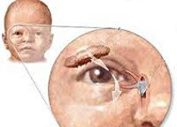 Особенности и симптомы конъюнктивита и дакриоцистита у младенцев
