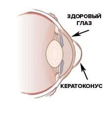 кератоконус - это
