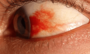 Что делать если лопнул сосуд в глазу? | Сеть офтальмологических центров Визиум