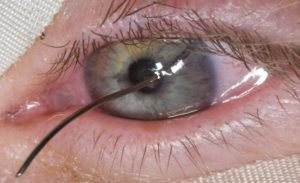 Лопнул кровеносный сосуд в глазу - что делать?
