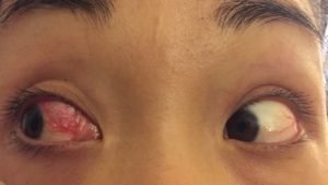 Что такое птеригиум
