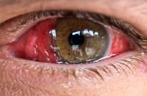 Химические ожоги глаз
