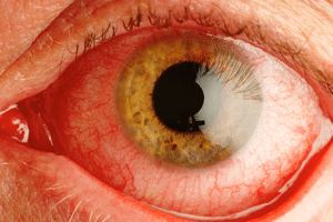 Список заболеваний глаз у человека - описание симптомов
