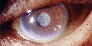 Капли для лечения катаракты - что лучше выбрать?
