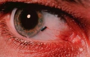 Ощущение присутствия инородного тела в глазу
