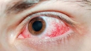 Химические ожоги глаз
