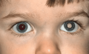 Белые зрачки или лейкорея
