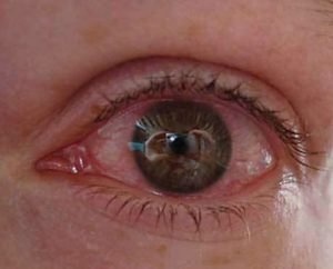 Холодок в глазах
