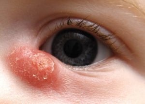 Дакриоцистит
