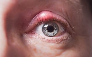 Холодок в глазах
