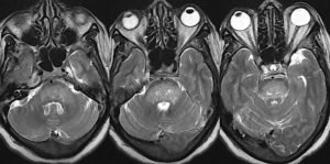 Почему возникают головные боли и боли в глазах
