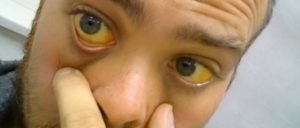 Почему желтеют глаза

