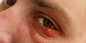 Может ли ячмень вызвать лихорадку
