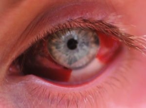 Как лечить кровотечение в глазу
