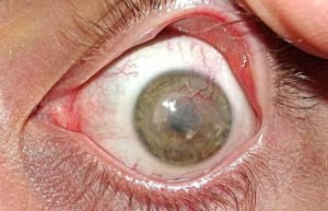 Ощущение инородного тела в глазу
