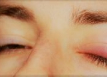 Опухшее веко и опухший глаз - это признаки воспаления, которое может возникнуть при инфекциях, вирусах и травмах. Воспаление является первым симпто...