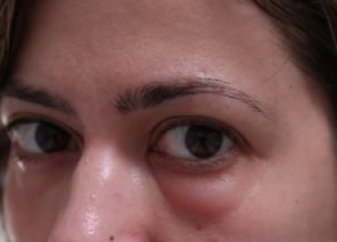 Отёк - это скопление жидкости в определённых слоях кожи. Она сопровождается болью, дискомфортом и покалыванием. Кожа вокруг глаз очень тонкая ...