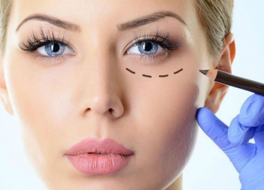 Блефаропластика нижних век (UEB) – одна из наиболее часто выполняемых эстетических процедур для лица. С ее помощью можно удалить избыток кожи и жир...