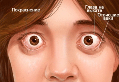 Эндокринная офтальмопатия
