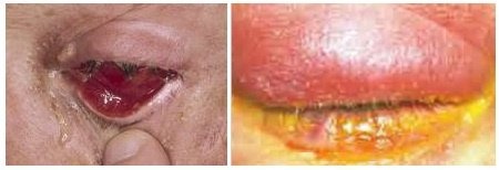 Аденовирусные, вирусные увеиты
