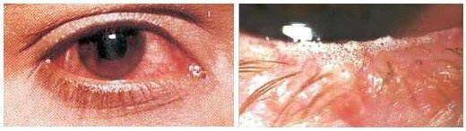 Грибковый увеит, обследование глаз на наличие грибков
