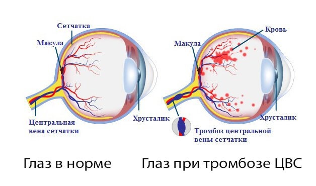 Современное лечение тромбоза церебральных сосудов