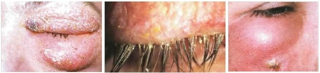 Бактериальное воспаление ободка век
