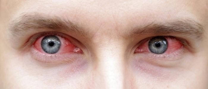 Сегментарный увеит
