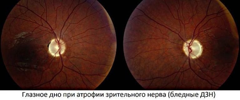 Список заболеваний глаз у человека - описание симптомов
