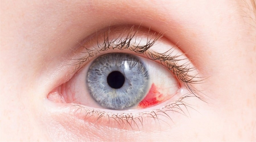 Почему лопаются кровеносные сосуды?
