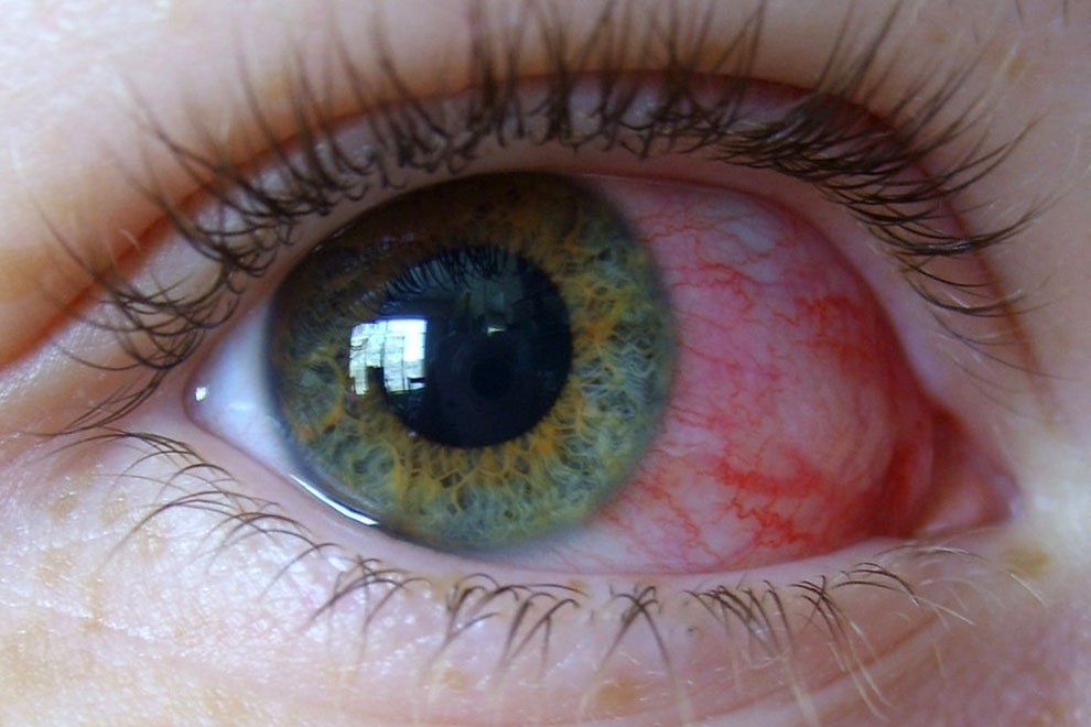 Как лечить кровоизлияние в глаз
